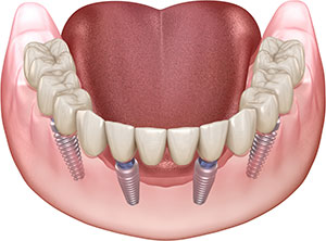 Illustration of All-on-Four implants