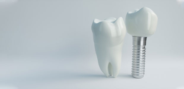 Model of tooth and model of implant