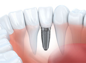 Diagram of dental implant